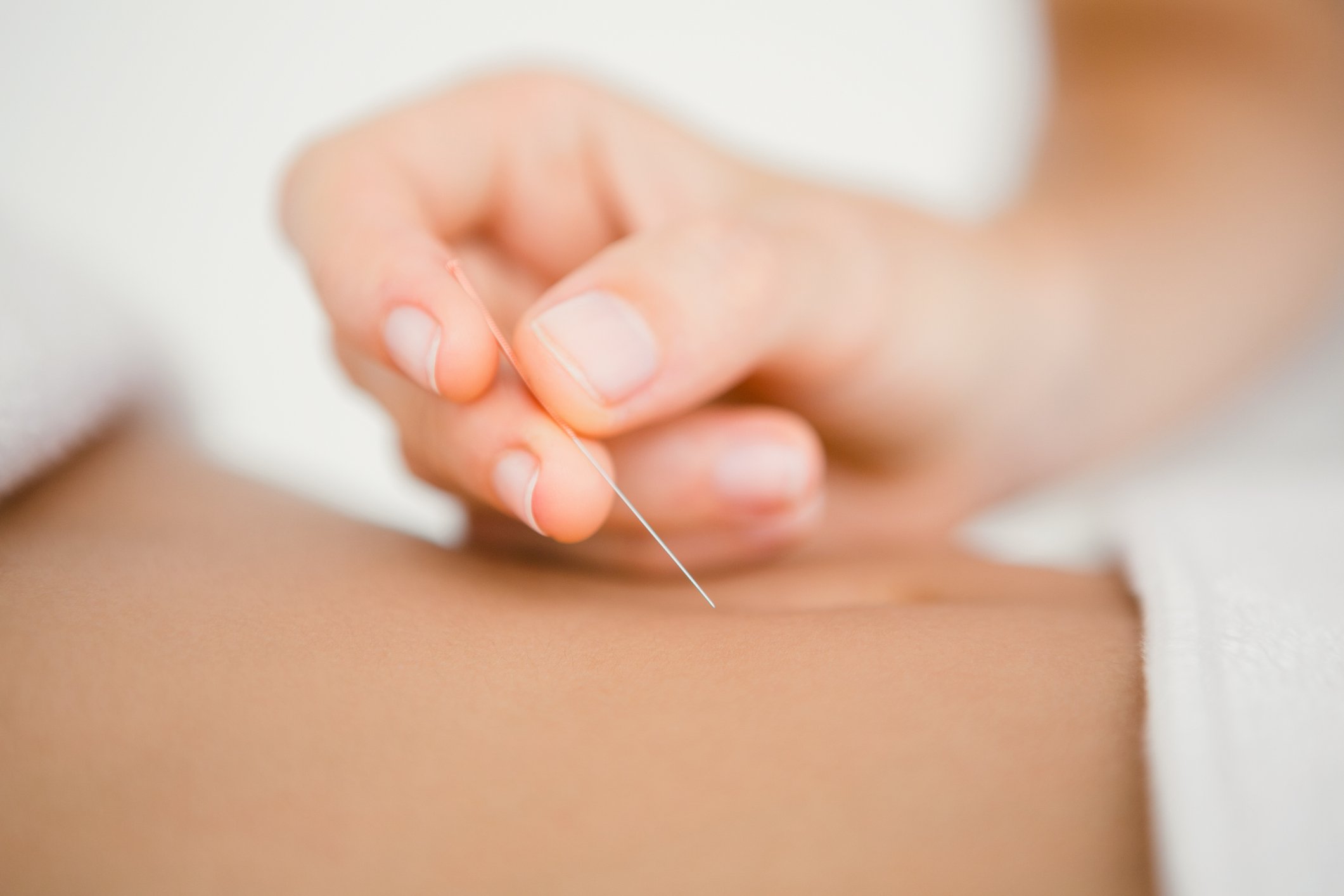 5 benefits of acupuncture